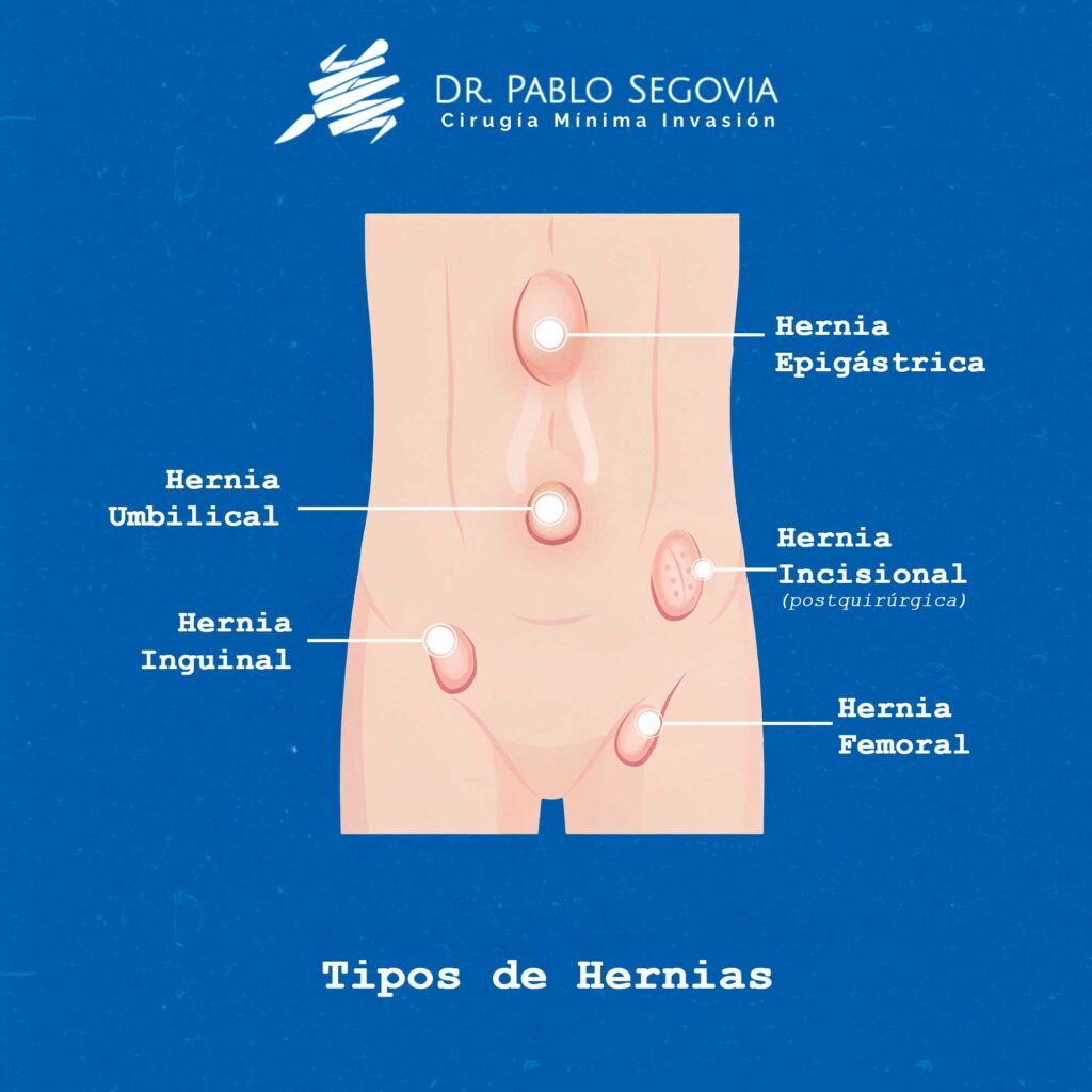 tiposdehernias2